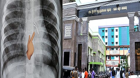 எல்இடி பல்ப்-பை விழுங்கிய குழந்தைக்கு நுரையீரல் அகநோக்கி சிகிச்சை