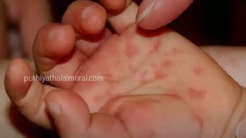 தக்காளி காய்ச்சல்