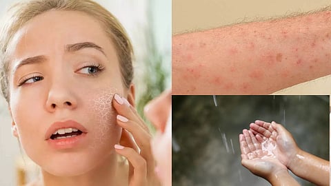 சரும பிரச்னை