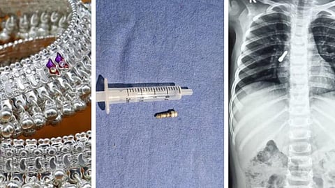 திருச்சி: 3 வயது சிறுவன் மூச்சுக்குழாயில் சிக்கிய கொலுசு திருகாணி!