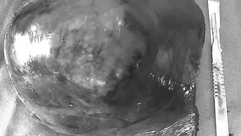 புற்றுநோய் கட்டி