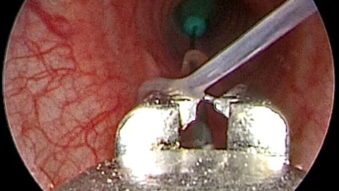 பெண்ணின் மூச்சுக் குழாயில் சிக்கியிருந்த ஊசி