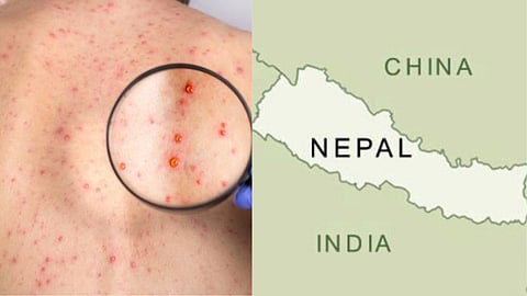rubella eliminated in nepal and where india stands