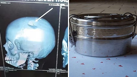 சிறுமியை டிபன் பாக்ஸால் தாக்கிய ஆசிரியர்