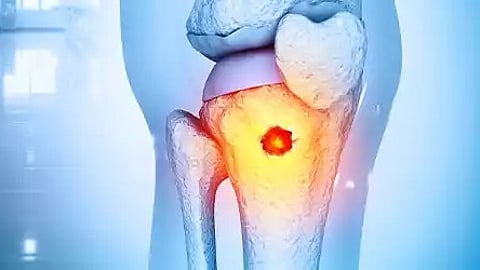 எலும்பு மஜ்ஜையை பாதிக்கும் நோய்கள்