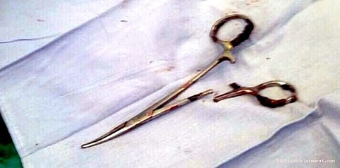 18 ஆண்டுகளாக வயிற்றில் இருந்த கத்திரிக்கோல்