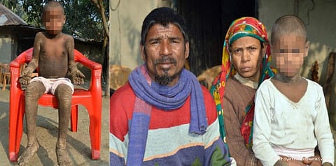 கல் போன்று மாறிவரும் 8 வயது சிறுவன்