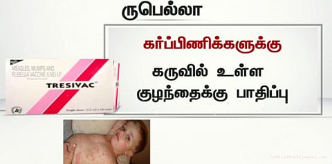 தட்டம்மை நோயின் அறிகுறிகள்