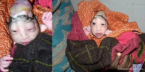 ஏலியன் போல் பிறந்த குழந்தை...அதிர்ச்சியில் பெற்றோர்கள்