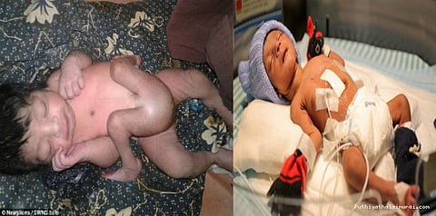 நான்கு கால்களுடன் பிறந்த குழந்தைக்கு தேவையற்ற கால்கள் நீக்கம்