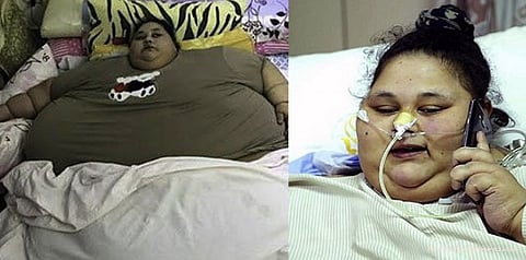 எடை குறைஞ்சது, ஆனால் கால் போச்சே: குண்டுப் பெண்மணியின் சோகம்