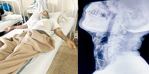 ஆத்தாடி! ரயில்வே ஊழியரின் உடலுக்குள் 75 ஊசிகள்: டாக்டர்கள் ஷாக்