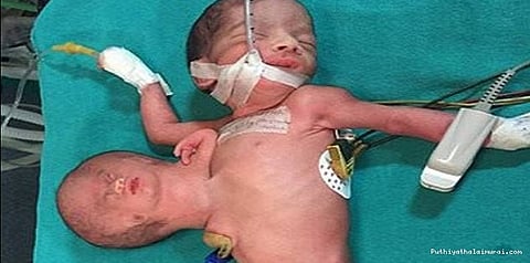 வயிற்றில் தலையுடன் பிறந்த அதிசய குழந்தை