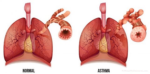 ஆஸ்துமாவை சமாளிக்க எளிய வழிகள்