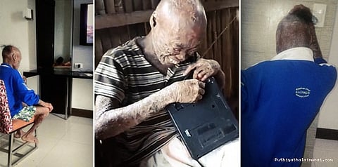 'பேய் மனிதன்னு சொல்றாங்க': அரிய நோயால் இளைஞர் அல்லல்!