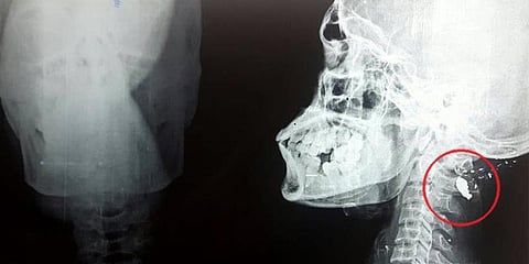 மண்டைக்குள் புல்லட்: பரிதவித்த டாக்டர்கள்!