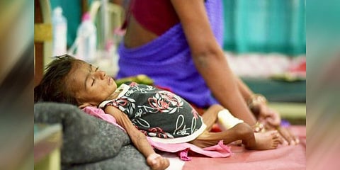 ஊட்டச்சத்து குறைபாடு: நாள் ஒன்றுக்கு 6 ஆயிரம் இந்தியக் குழந்தைகள் பலி