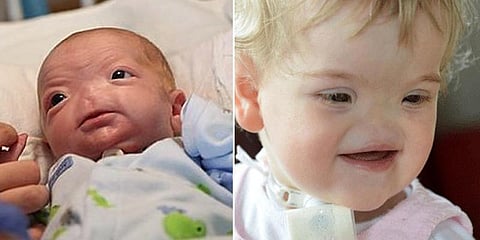 மூக்கில்லாமல் பிறந்த குழந்தை... 2 ஆண்டுகளுக்குபின் உயிரிழப்பு