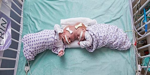 ஆபரேஷன் சக்சஸ்: ஒட்டி பிறந்த இரட்டையர்கள் பிரிந்தனர்!