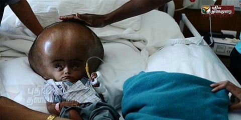 இயல்பு நிலையிலிருந்து 3 மடங்கு தலை வீங்கிய 5 வயது திரிபுரா சிறுமி மரணம்