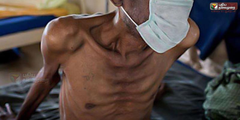 காசநோயாளிகள் நிதி உதவு பெற ஆதார் கட்டாயம்!