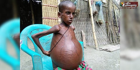 இரண்டு கால்பந்து அளவு வயிறு... விசித்திர நோயால் அவதிப்படும் சிறுவன்