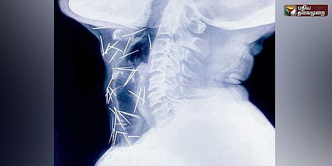 தொண்டைக்குள் 150 குண்டூசிகள் - அதிசய மனிதருக்கு ஆப்ரேஷன்