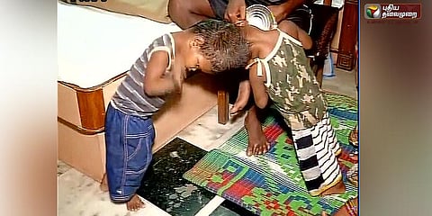 ஒட்டிப்பிறந்த இரட்டை குழந்தைகள்: எய்ம்ஸில் ஆபரேஷன்