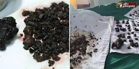 பெண்ணின் பித்தப்பையில் 200 கற்கள்: காலை உணவை தவிர்த்ததால் விபரீதம்