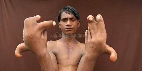 வினோதமான கைவிரல் கொண்ட சிறுவன்... சாபம் என ஒதுக்கும் கிராமமக்கள்