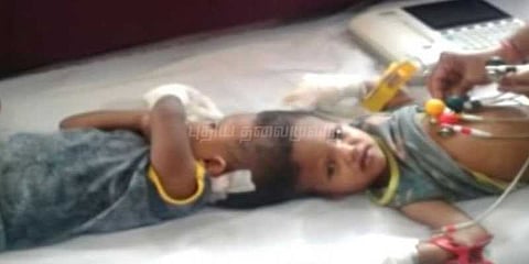 தலை ஒட்டிப் பிறந்த இரட்டையர்களுக்கு ஆபரேஷன் வெற்றி