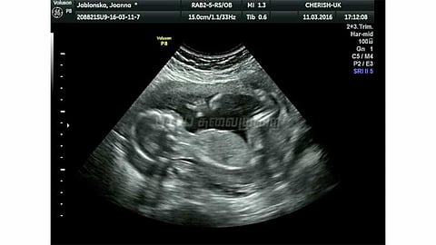 இணையம் மூலம் கருவின் பாலினம் கண்டறியும் வசதியை நீக்க புதிய அமைப்பு