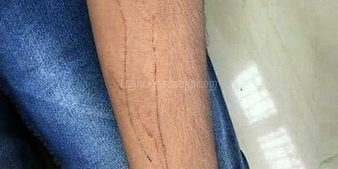 கத்தியால் கையில் திமிங்கலம் வரைய முயன்ற புதுச்சேரி இளைஞர் மீட்பு