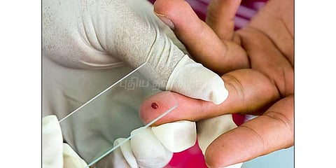 கிராமம் முழுவதும் காய்ச்சல்: 200க்கும் மேற்பட்டோர் பாதிப்பு