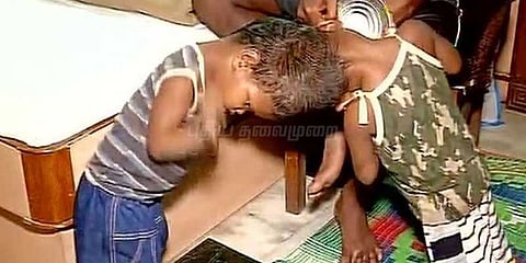 தலைஒட்டி பிறந்த குழந்தைகள் நீண்ட அறுவை சிகிச்சைக்குப் பின் பிரிப்பு