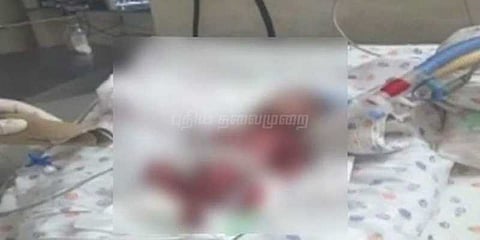 உயிருள்ள குழந்தையை இறந்ததாக அறிவித்த மருத்துவமனை : மத்திய அமைச்சர் கண்டனம்