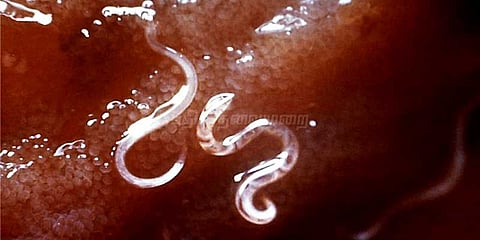 சிறுவன் உடலில் 22 லிட்டர் ரத்தம் உறிஞ்சிய புழுக்கள்!