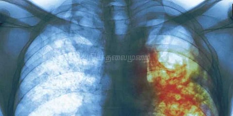 காசநோயாளிகளுக்கு மாதந்தோறும் ரூ.500 வழங்க மத்திய அரசு முடிவு