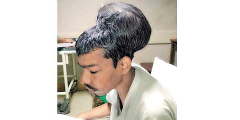 7 மணி நேர போராட்டம்: மண்டையில் இருந்து 2 கிலோ கட்டியை நீக்கிய ’திறமை’ டாக்டர்கள்!