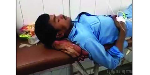 நோயாளிக்கு தலையணையானது துண்டிக்கப்பட்ட கால்: உ.பி. மருத்துவமனையில் அவலம்