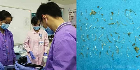 வயிற்றுக்குள் சிக்கிய 100 மீன் முட்கள்!