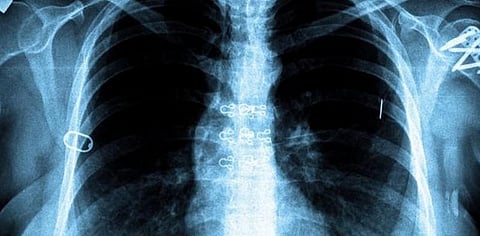 தமிழ்நாட்டில் அதிகரிக்கும் காசநோய் பாதிப்பு - ஆய்வறிக்கை