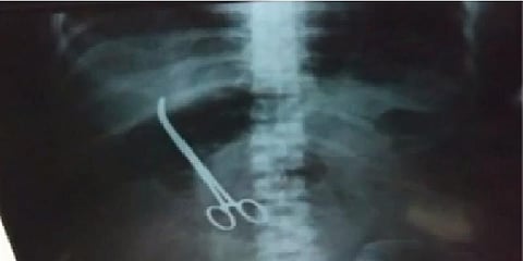 அறுவைச் சிகிச்சை செய்த பெண் வயிற்றில் கத்தரிகோல் - உறவினர் பதட்டம்