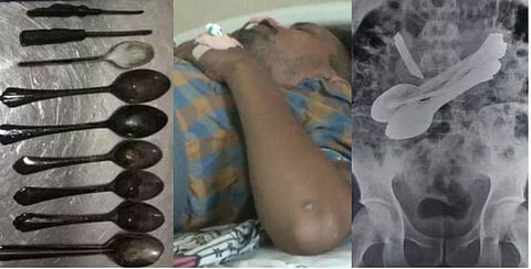 வயிற்றுக்குள், 8 ஸ்பூன், 2 டூத் பிரஷ், 2 ஸ்குரூ டிரைவர், 1 கத்தி: அதிர்ச்சி அடைந்த மருத்துவர்கள்!