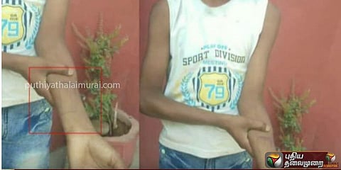 கட்டணம் செலுத்தாத மாணவர் கையில் முத்திரை பதித்த பள்ளி நிர்வாகம்