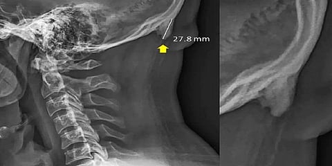 ''செல்போன் அடிக்டுகளுக்கு கொம்பு முளைக்கும்'' - விஞ்ஞானிகள் அதிர்ச்சி தகவல்