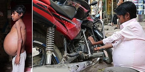 வீங்கிச் செல்லும் வயிறு: விசித்திர நோயால் தவிக்கும் கார் மெக்கானிக்!