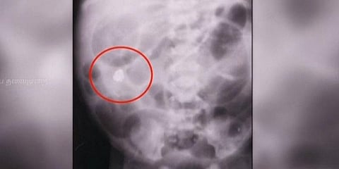 பச்சிளம் குழந்தைக்கு பாதரசம் கலந்து கொடுத்த கொடுமை