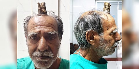 விவசாயி தலையில் 4 இன்ச் ’கொம்பு’: ஆபரேஷன் மூலம் நீக்கம்