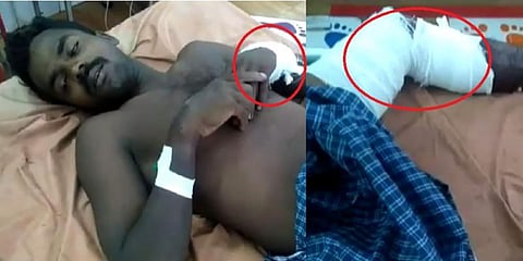 கை, கால்களை கடித்த காட்டுப்பன்றி - இரண்டு விவசாயிகள் படுகாயம்